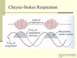 Image result for Cheyne-Stokes Respiration