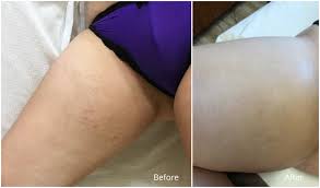 Developed designed for the stretch marks of mommy before and after the birth, it contains mango essence and a variety of plant nutrition repair ingredients, which is easy to the skin looks softer and fairer. Treating Stretch Marks In St Louis St Louis Liposuction
