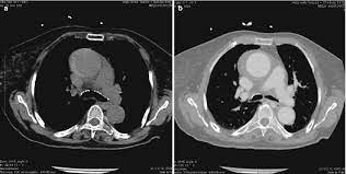 I miss you, please grace me with your presence. Acute Aortic Syndrome Springerlink