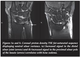 Comparison Of Diaphyseal And Metaphyseal Ulnar Shortening Osteotomies For  The Treatment Of Ulnar Impaction Syndrome | Bmc Musculoskeletal Disorders |  Full Text