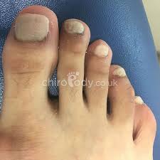 One of my favourite hygienic places for everything in nails. Toenail Reconstruction Services Manchester Podiatry Leading Podiatry Provider In Manchester