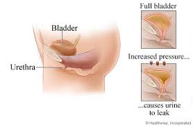 Kegel Exercises For Urinary Incontinence My Doctor Online