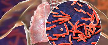 Tuberculosis (tb) is an infectious disease usually caused by mycobacterium tuberculosis (mtb) bacteria. Ù…Ø±Ø¶ Ø§Ù„Ø³Ù„ Ø§Ù„Ø§Ø¹Ø±Ø§Ø¶ ÙˆØ§Ù„Ø§Ø³Ø¨Ø§Ø¨ ÙˆÙŠØ¨ Ø·Ø¨
