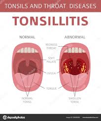 Tonsils Throat Diseases Tonsillitis Symptoms Treatment Icon