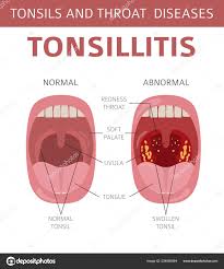 tonsils throat diseases tonsillitis symptoms treatment icon