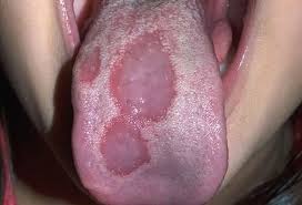 Image result for mouth ulcer on tongue)