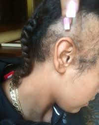 Easy hair braiding tutorials for step by step hairstyles. Braids Made Me Lose My Hair And I Used Mascara To Cover Up My Growing Bald Patch