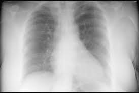 Image result for CHF Observation Unit