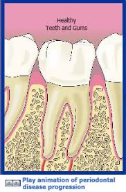 And, gradually, it progresses into periodontitis, a more severe form of gum disease. Types Of Gum Disease Perio Org
