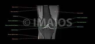 · 2, infrapatellar fat pad of hoffa. The Knee Mri Atlas Of Anatomy In Medical Imagery