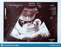 Ultrassom De Uma Crianca 20 Semanas 5 Meses Imagem De Stock Imagem De Matriz Varredura 168390097