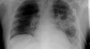 Quais s&atilde;o os sintomas da pneumonia bacteriana e qual &eacute; o tratamento? -  M&eacute;dico Responde