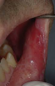 Image result for Erythroplakia roof of mouth