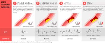 Rise or fall of cardiac biomarker values with at least one value. Acute Coronary Syndrome Acs Definitions Stable Grepmed