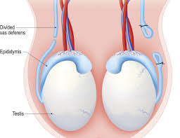 We did not find results for: Vasectomy Reversal Procedure Recovery And Risks