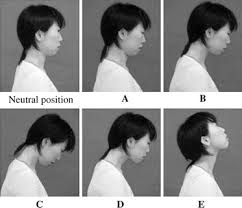 So while extension of a joint refers to stretching it or straightening it within its normal limits, hyperextension refers to stretching neck arthritis? Figure 1 What Is The Chin Down Posture A Questionnaire Survey Of Speech Language Pathologists In Japan And The United States Springerlink