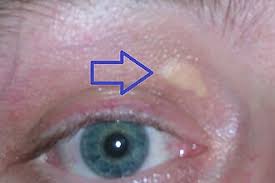 Image result for xantelasma