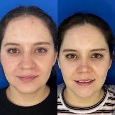 El botox siempre es nuestro...