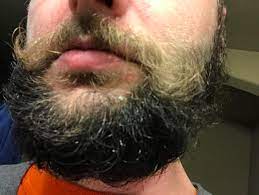 If you haven't noticed, tons of women get facial hair. How To Get Rid Of The Flakes And The Dry Skin Moustache Is Blonde So It S Even More Noticeable In That Area Beardadvice