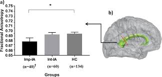 Impaired Illness Awareness In Schizophrenia And Posterior