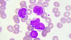 We did not find results for: Hallan Biomarcadores Predictivos De Recaida En Leucemia Mieloide Cronica