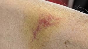 Image result for erysipel photos)