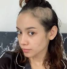 Bea Benedicto gets real about getting 'depressed, anxious and balding'