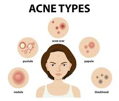 A diferencia de las espinillas, presentan un aspecto más interno y se perciben como abultamientos epidérmicos. Tipos De Acne En La Piel O Espinillas Vector Gratis