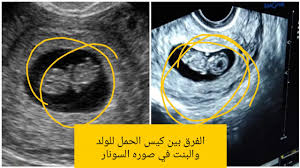 الفرق بين شكل كيس الحمل للجنين الولد والانثي هتعرفي بنفسك انتي حامل في ايه من صوره السونار Youtube