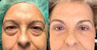 Blefaroplastia Superior E Inferior Caso Clinico 41530