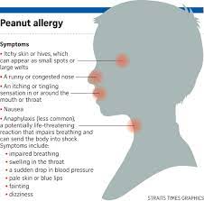Immunology Twitterissa Peanut Allergy Symptoms 1 Itchyskin Or Hives Which Can Appear As Small Spots Or Large Welts 2 Nausea 3 A Runny Or Congestednose 4 Anaphylaxis Https T Co D9hl6ozhzk