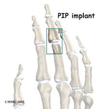 The true cost of a finger surgery for something such as a dislocated or broken finger. Physical Therapy In Binghamton For Swan Neck Deformity Of The Finger