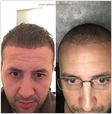 زراعة الشعر تركيا قبل وبعد Hair Transplant Best Hair Transplant Cool Hairstyles