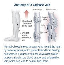 Varicose Veins Guide: Causes, Symptoms And Treatment Options