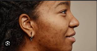 can i use scenar for acne? if yes how?