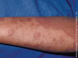 ¿cómo se dice sarpullido en inglés? Dermatitis Atopica Piel Seca Tratamiento Infecciones De La Piel