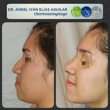 Dr. Ángel Elías Otorrinolaringologo