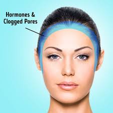 If you find yourself dealing with hairline acne, fortunately there are several things you can do to help prevent and treat those frustrating pimples, blackheads, and breakouts. What The Acne Map Is And How It Can Help You Get Rid Of Health Problems
