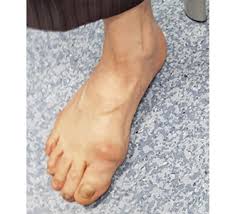 The most common bone spur on the side of the foot is a bunion which is an enlargement of bone just behind the big toe. Big Toe Joint Pain Treatment Sydney Big Toe Joint Pain Treatment Sydney