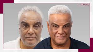 Satish Menon: Beyond the Boundary Ropes, A Personal Innings with Hair  Transplant and Transformation