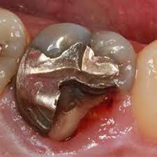 Pin On Protesis