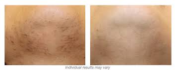 Laser hair removal can help minimise the effects of folliculitis on hair follicles. Hinsdale Laser Hair Removal Laser Aesthetic Center