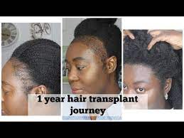 My 1 Year Hair Transplant Journey Youtube Hair Transplant Transplant Hair Transplant Surgery