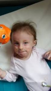 Edwards' syndrome is associated with the presence of a third copy of chromosome number 18. Girl 4 Defying All The Odds Living With Rare Genetic Disorder That Kills Most Before First Birthday Bristol Live