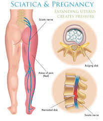 But as your body adjusts to the shift in hormones that expecting a baby produces, this normally subsides for most women. Has Sciatica Sidelined You During Pregnancy Compass Family Chiropractic