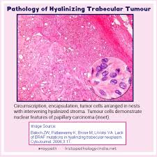 Educational Gif Pathology Of Hyalinizing Trabecular Tumour Pathology Medicine Notes Tumor