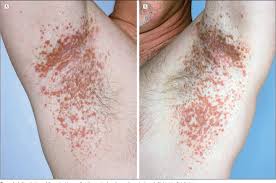 I assume you are asking about the eyelid subtype of xanthomas known as xanthelasmata. Pdf Xanthoma Disseminatum Effective Therapy With 2 Chlorodeoxyadenosine In A Case Series Semantic Scholar