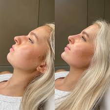 LIPS & CHIN ✨ By Bethany. Want these kind of natural tweaks? We're the  injectors for you🙋🏻‍♀️ We specialise in facial harmony, so if that's what  you're after, natural tweaks… we got