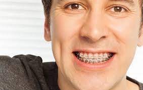 Es gibt die lingualtechnik mit silberfarbenen oder goldfarbenen brackets. Zahnspange Upd