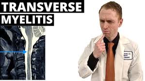 Image result for Myelitis